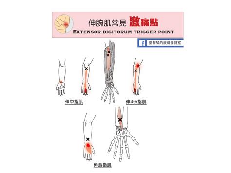 手受傷|手肘痛、手腕痛、手指痛的原因,治療與自我檢查 » 台。